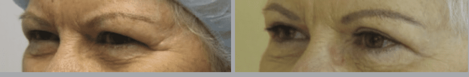 Screenshot 2024-08-09 at 9.37.19 PM Eyelid Surgery or Blepharoplasty in Ventura, CA